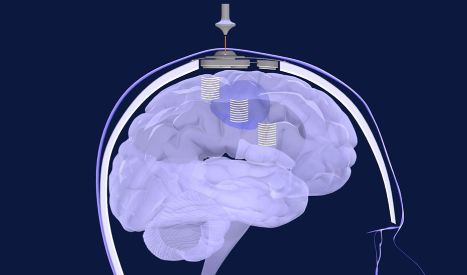 
			      Dispositivo del ensayo clínico internacional \u0027Sonobird\u0027, contra el glioblastoma recurrente.			    
			  